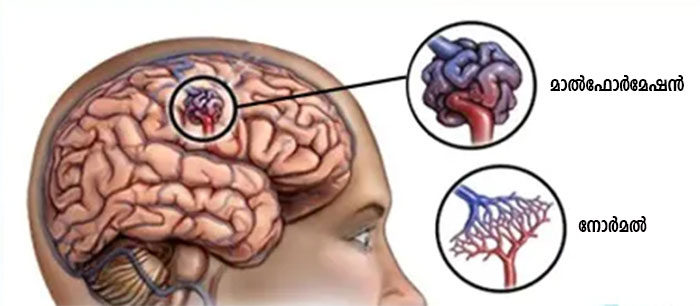 difference between normal brain blood vessals vs AVM brain